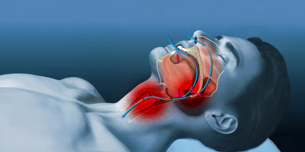 The Secret Reason Why Losing Weight Won’t Fix Your Snoring